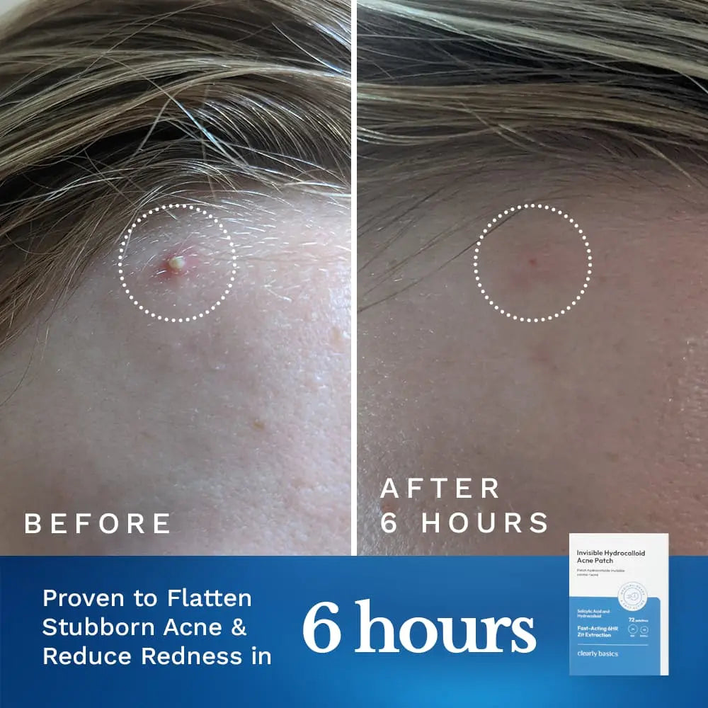 Invisible Acne Patch